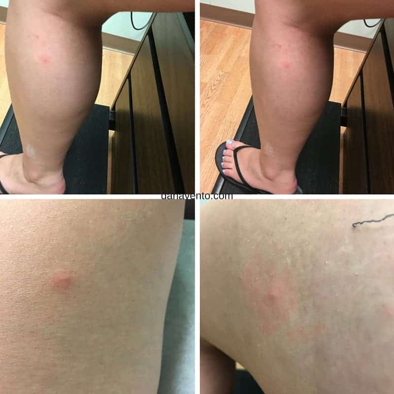 Chigger Bug Bites on my daughter from Lake Erie Area 