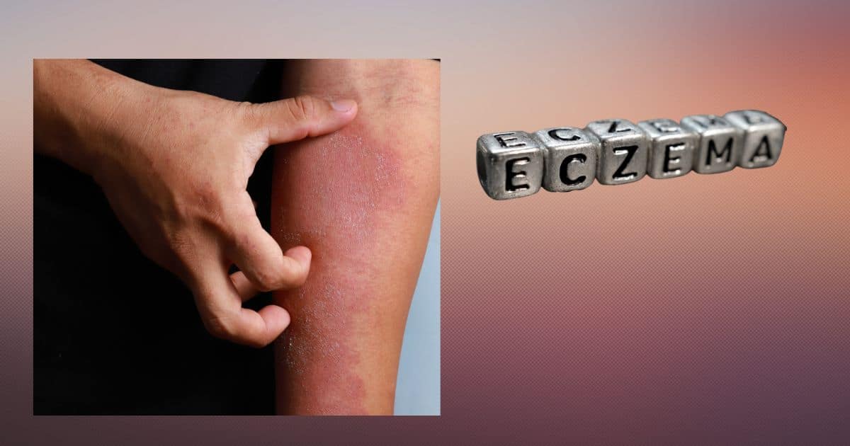 Eczema Flare Ups + Unlocking Relief From The Top 5 Symptoms 