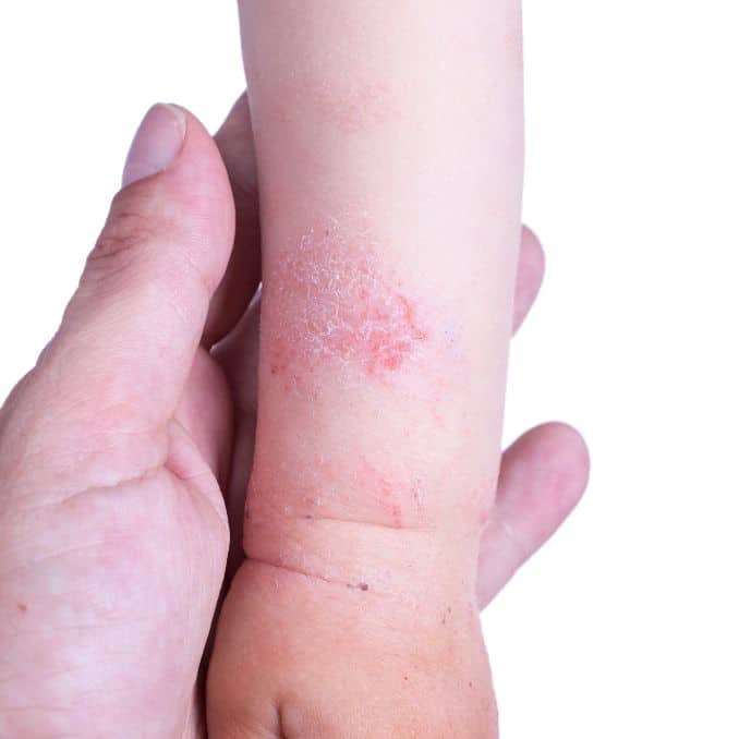 Unlock Relief From The Top 5 Symptoms of Eczema Flare Ups
